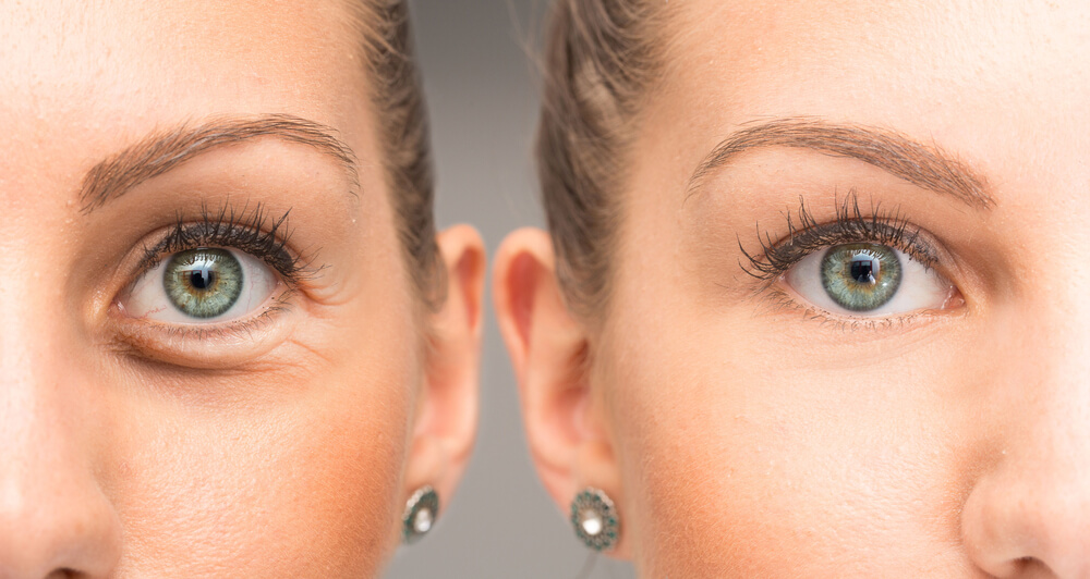 Mujer antes y después de tener bolsas en los ojos